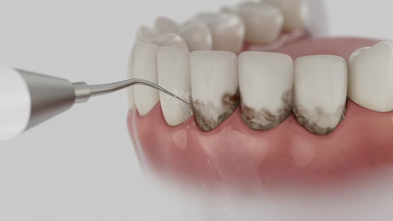 Reliable Tooth Extraction contractor in Lafayette, IN by Smile Center Dentistry